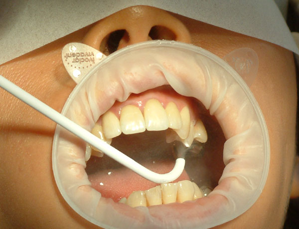 Wybielanie zębów -bezpieczeństwo zabiegu
