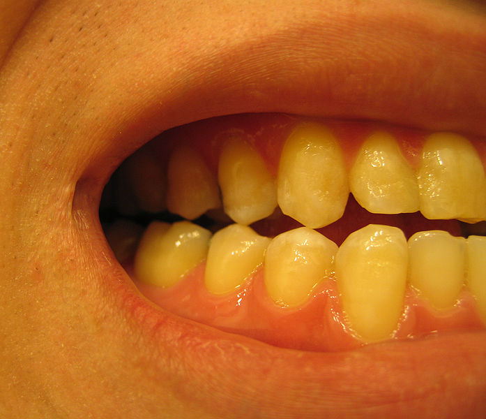 Zabiegi dentystyczne w narkozie